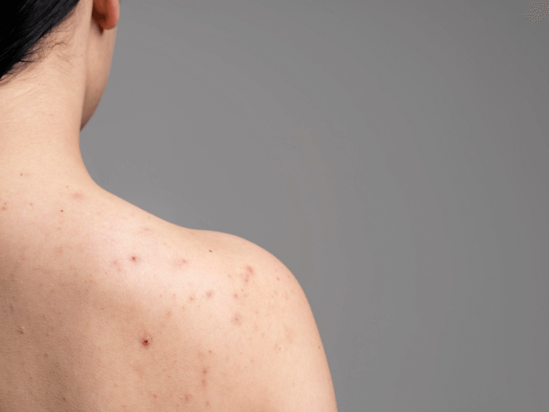 How to Choose the Right Bacne Treatment for Your Skin Type in Singapore