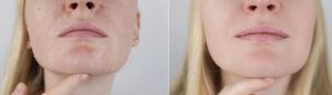 Dehydrated skin vs hydrated skin