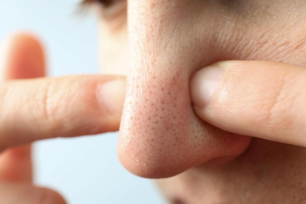 identifying-the-difference-how-to-know-if-its-sebaceous-filaments-or-blackheads.jpg