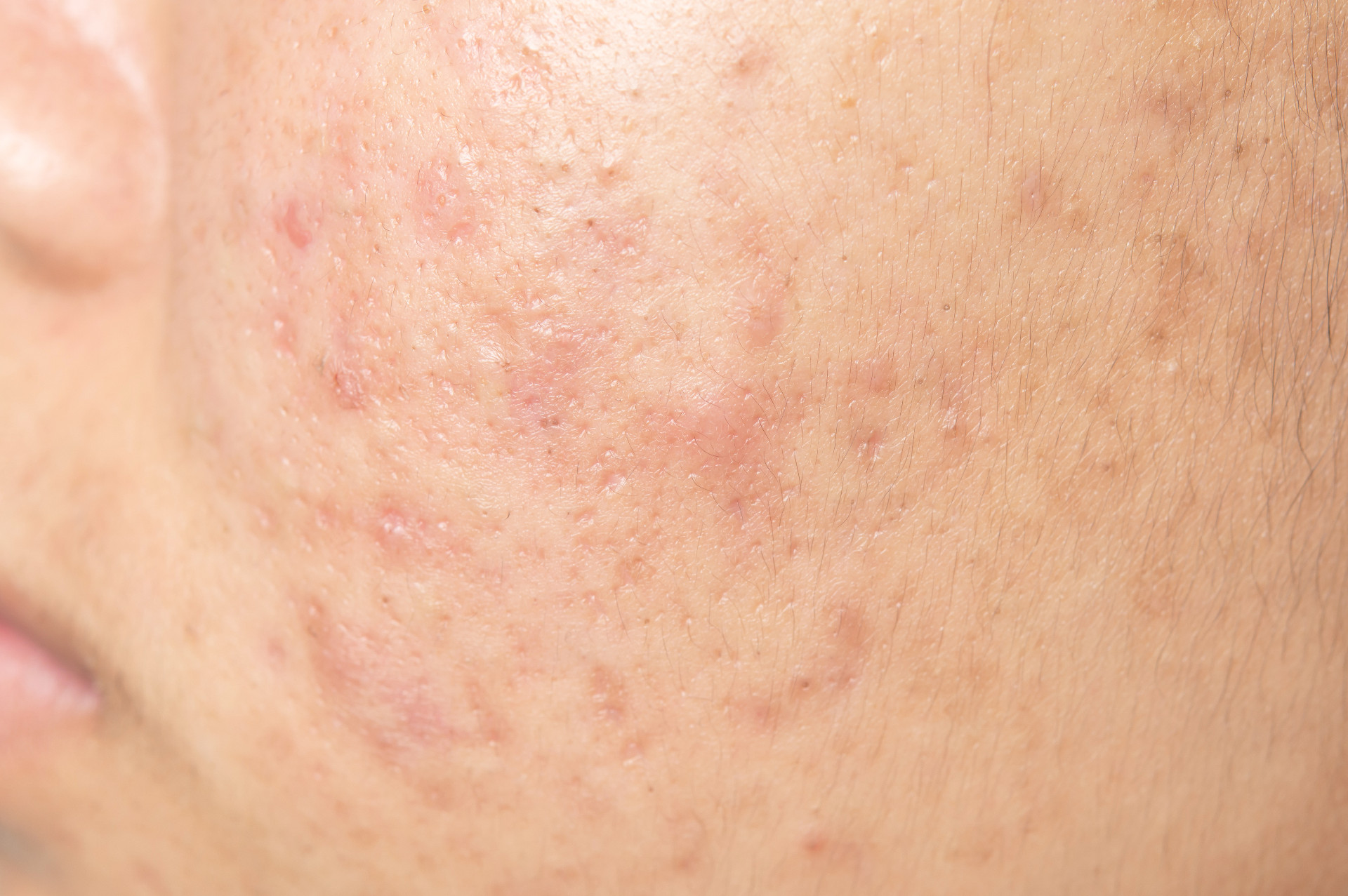 How to Remove Acne Scars in Singapore