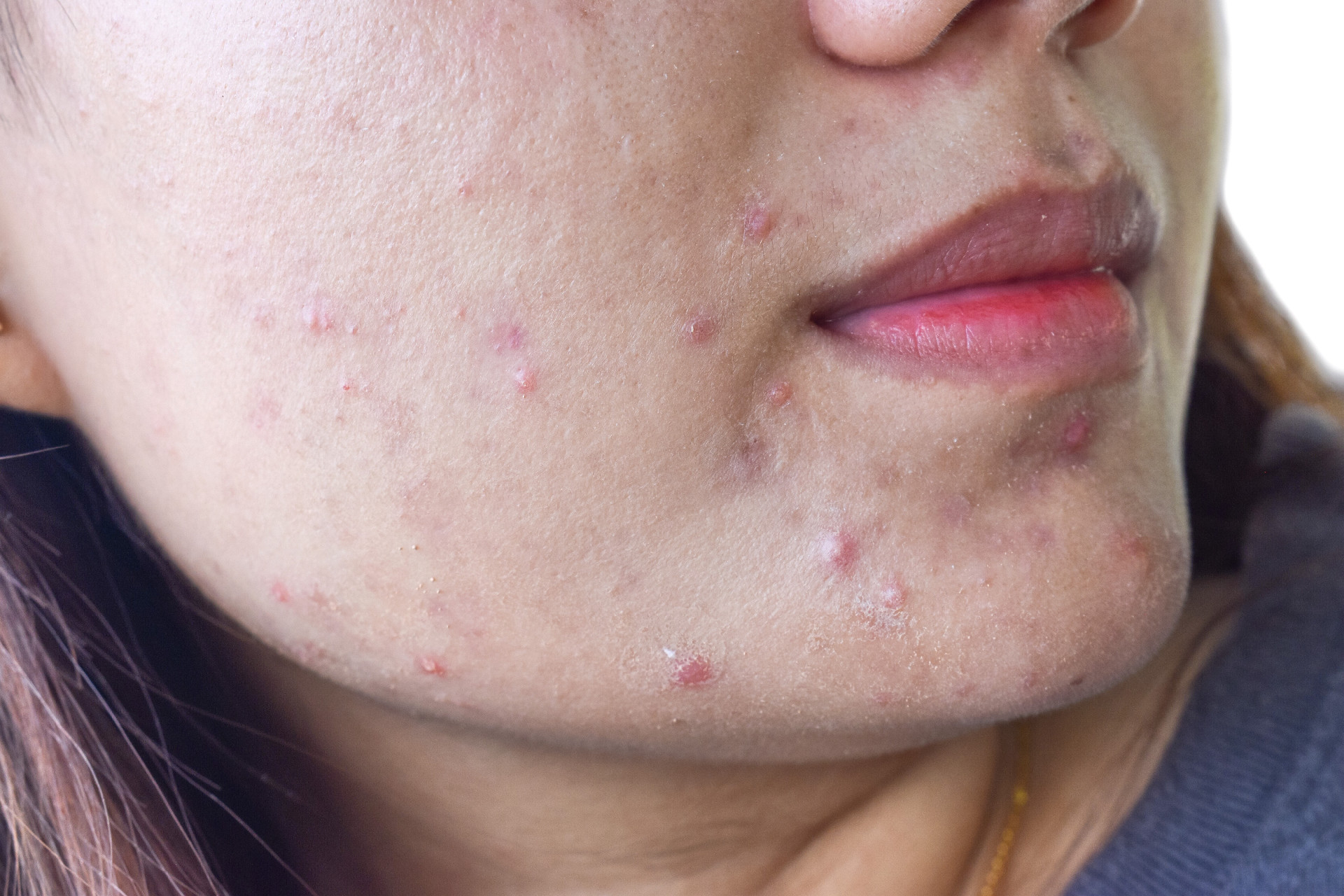 How to Calm Acne Flareups Fast
